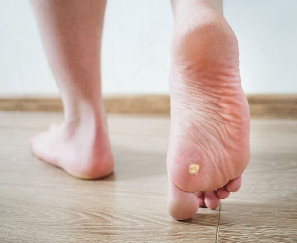 Diabetic Foot Ulcers